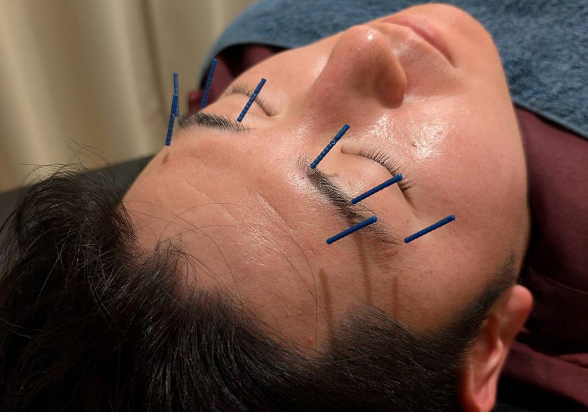 眼精疲労の施術について