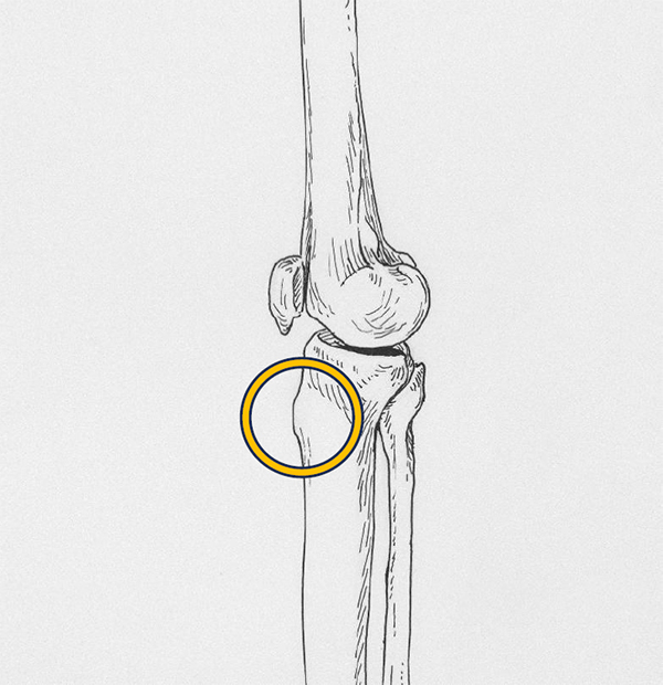 オスグッド・シュラッター病